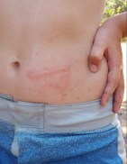 Manetmärket på Leos mage ser ut som blixten i Harry Potters panna